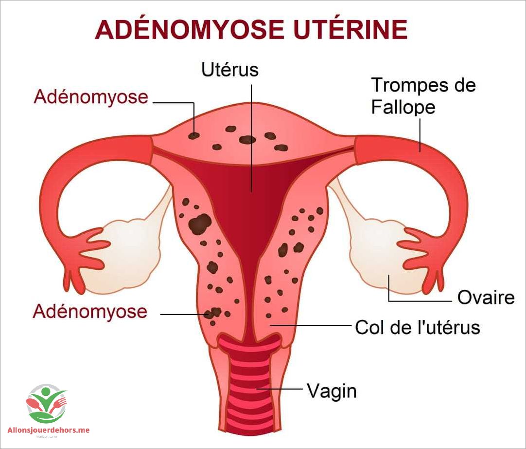 Fertilité et adénomyose