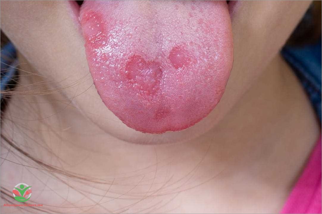 Bouton sur la langue  causes symptômes et traitements