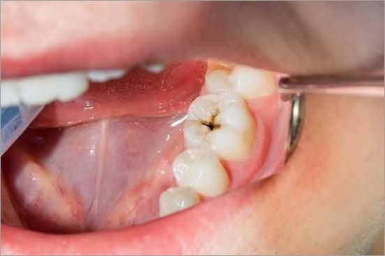 Carie dentaire : symptômes, causes et traitements