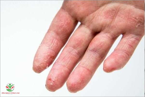 Cloque sur les mains causes symptômes et traitements