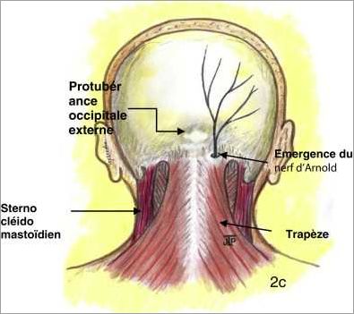 Complications de la névralgie d'Arnold  symptômes diagnostic et traitements