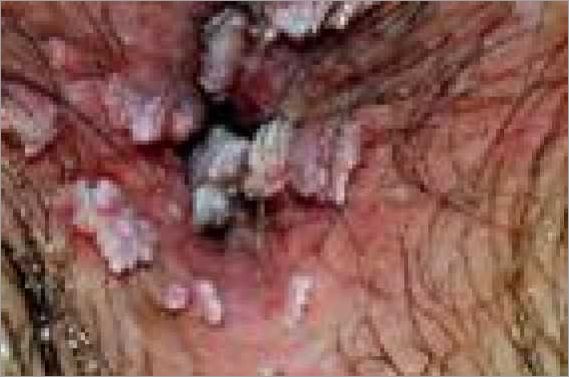 Condylome femme photo  symptômes causes et traitements des verrues génitales chez les femmes