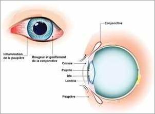 Conjonctivite oeil gonflé symptômes causes et traitements