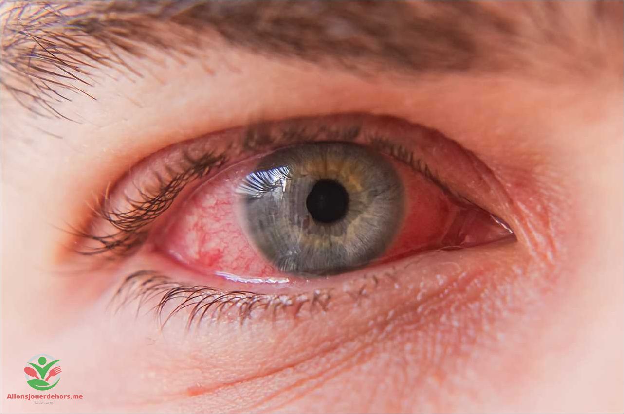 Symptômes de la conjonctivite œil gonflé