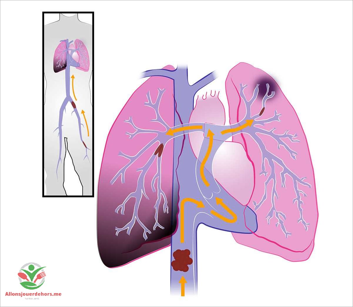 Facteurs de risque de l'embolie pulmonaire