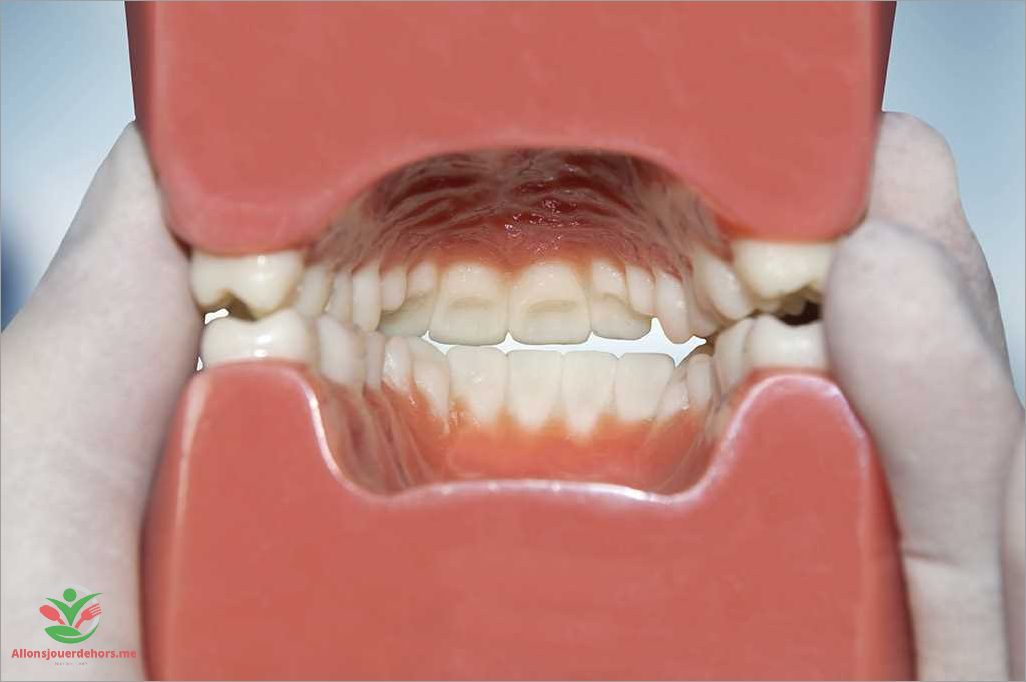 Causes de la casse des dents