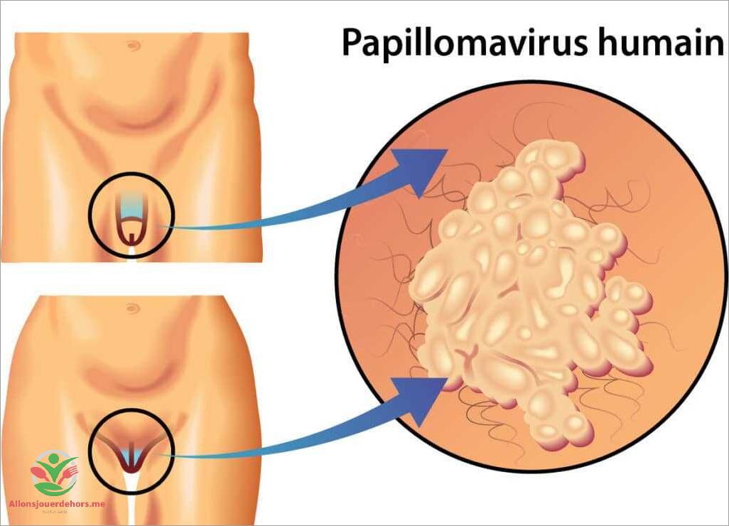 Dépistage du papillomavirus chez l'homme tout ce que vous devez savoir