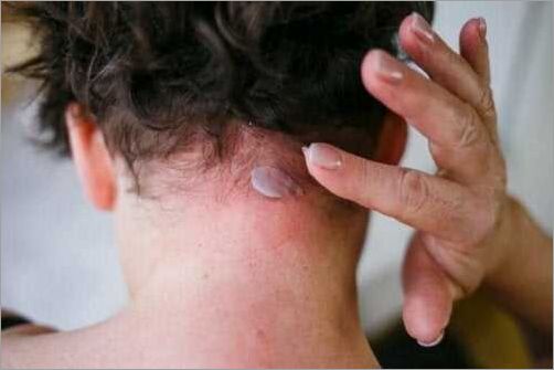 Dermite séborrhéique cheveux symptômes causes et traitements