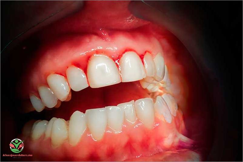 Saignements lors du brossage ou du passage de la soie dentaire