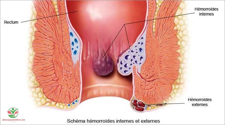 Hémorroïdes et flatulences causes symptômes et traitements