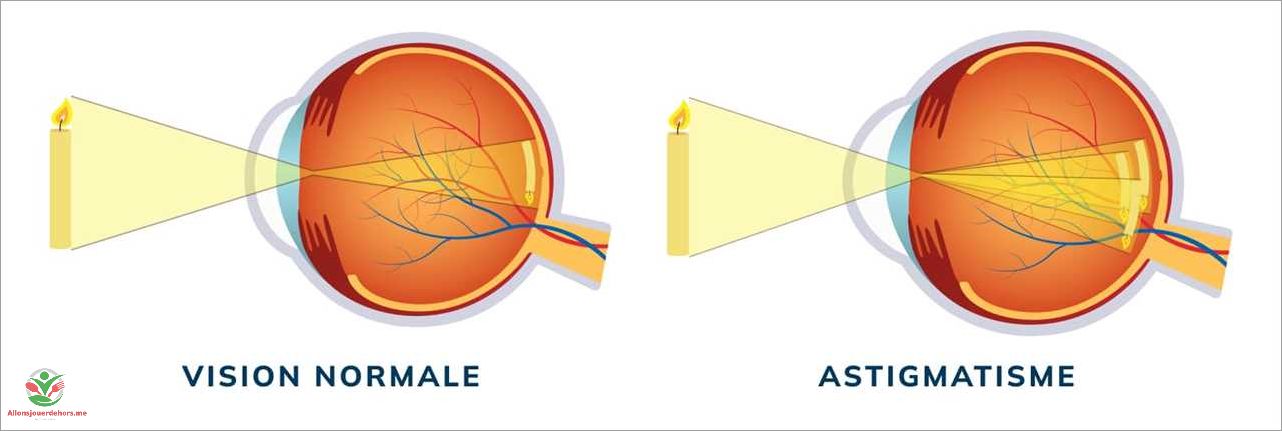 Hypermétrope et astigmate  tout savoir sur ces troubles de la vision