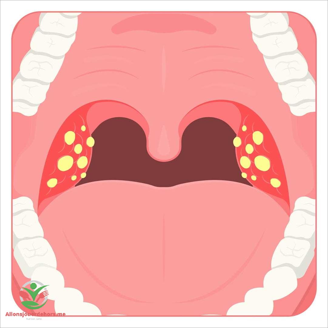 Qu'est-ce que la langue blanche angine ?