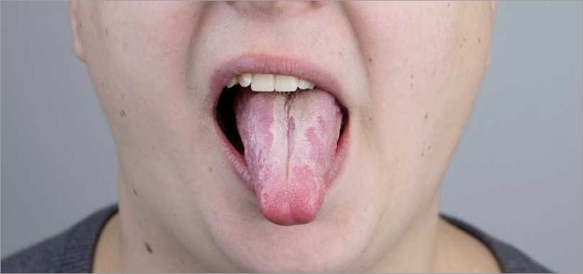 Causes du muguet dans la bouche