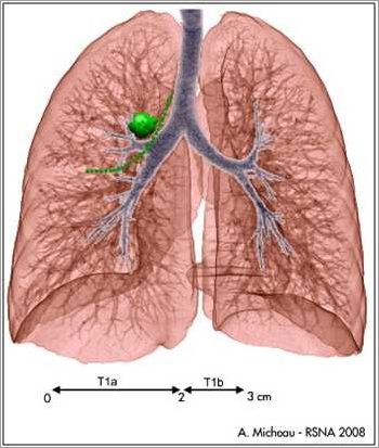 Les caractéristiques des nodules aux poumons