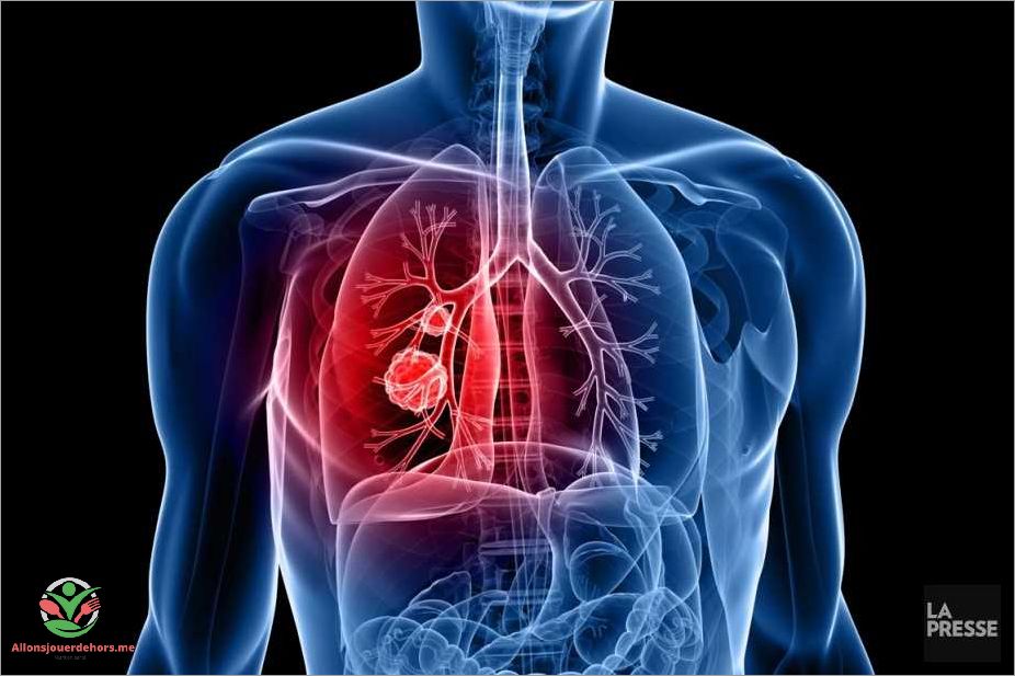 Les causes possibles des nodules aux poumons