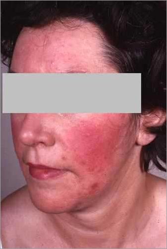 Symptômes des plaques rouges sur le visage