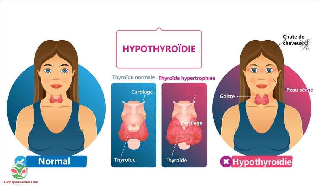 Inflammation de la thyroïde