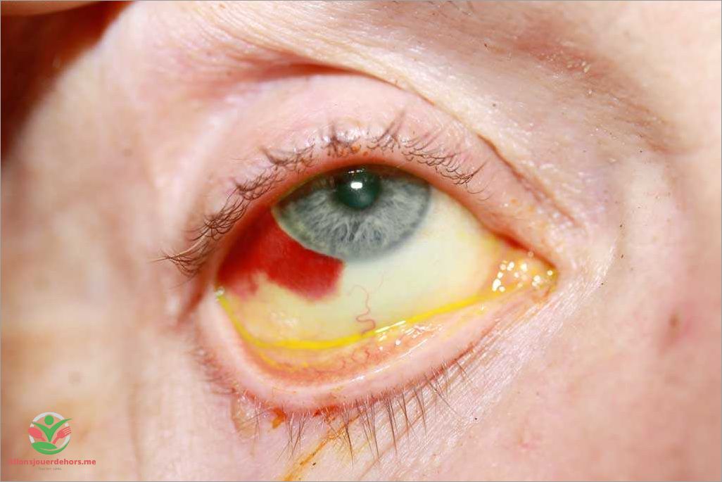 Sang dans l'oeil  causes symptômes et traitements