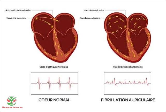 Types d'arythmies cardiaques
