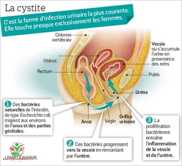 Symptômes d'une infection urinaire