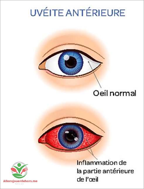 Causes de la tache noire oeil